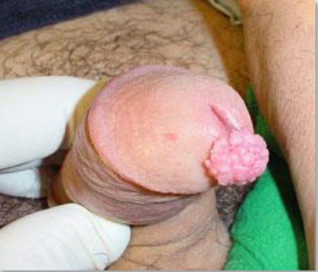 Meatal lesion